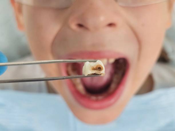 Best Emergency Treatment for Oral Infections in Baltic, SD